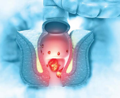 Các bước tầm soát ung thư ống hậu môn